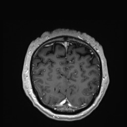 Cerebral arteriovenous malformation (Radiopaedia 84015-99245 Coronal T1 C+ 142).jpg