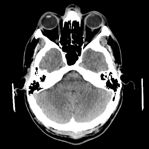 Cerebral arteriovenous malformation (Spetzler-Martin grade 2) (Radiopaedia 41262-44076 Axial non-contrast 15).png