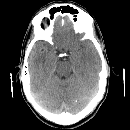 Cerebral arteriovenous malformation (Spetzler-Martin grade 2) (Radiopaedia 41262-44076 Axial non-contrast 21).png