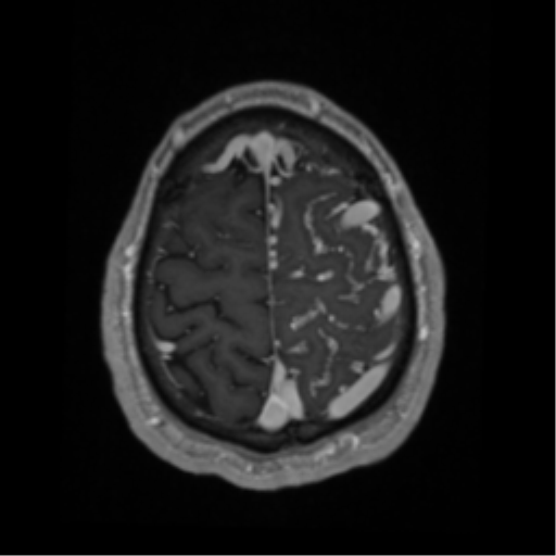 Cerebral arteriovenous malformation - huge (Radiopaedia 35734-37272 Axial T1 C+ 64).png