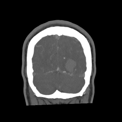 Cerebral arteriovenous malformation with lobar hemorrhage (Radiopaedia 35598-57216 C 79).jpg