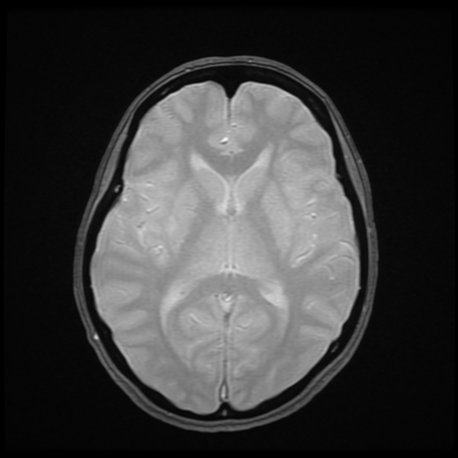 File:Cerebral autosomal dominant arteriopathy with subcortical infarcts and leukoencephalopathy (CADASIL) (Radiopaedia 41018-43768 Ax 2D MERGE 11).png