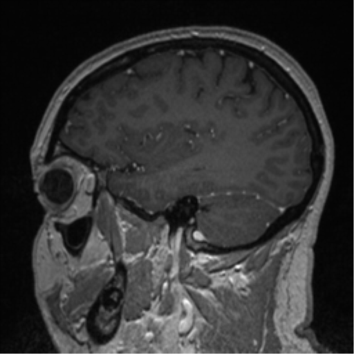 Cerebral cavernoma and development venous anomaly (Radiopaedia 37603-39482 Sagittal T1 C+ 28).png