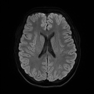 Cerebral cavernous venous malformation (Radiopaedia 70008-80021 Axial DWI 49).jpg