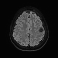 Cerebral cavernous venous malformation (Radiopaedia 70008-80021 Axial DWI 54).jpg