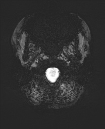 Cerebral cavernous venous malformation (Radiopaedia 70008-80021 Axial SWI 1).jpg