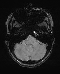 File:Cerebral cavernous venous malformation (Radiopaedia 70008-80021 I 15).jpg