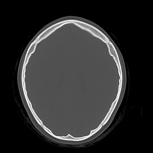Cerebral cavernous venous malformation (Radiopaedia 70008-80022 Axial bone window 33).jpg