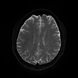 Cerebral cavernous venous malformation (Zabramski type II) (Radiopaedia 85511-101198 Axial DWI 87).jpg