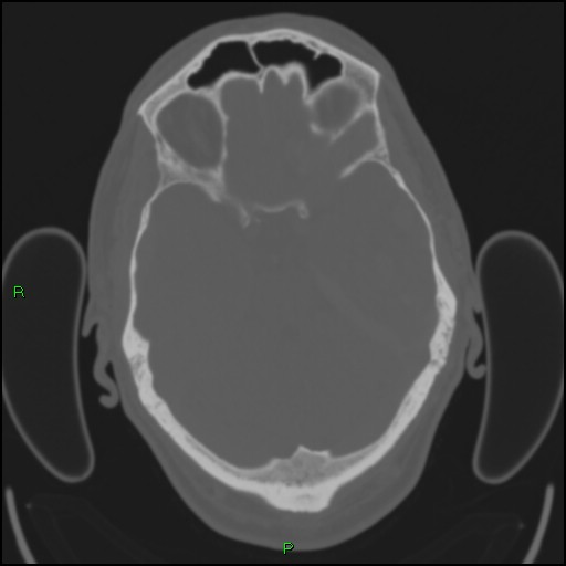 Cerebral contusions (Radiopaedia 33868-35039 Axial bone window 66).jpg