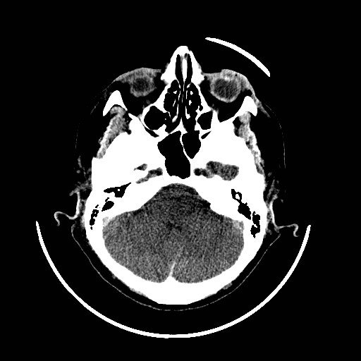 File:Cerebral edema (evolution in time) (Radiopaedia 19418-19439 non-contrast 24).jpg