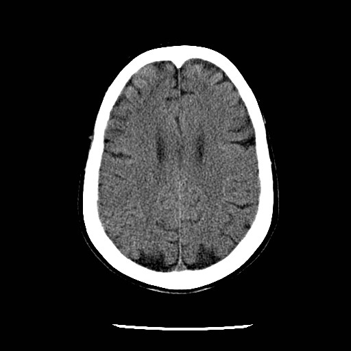 File:Cerebral edema (evolution in time) (Radiopaedia 19418-19441 non-contrast 67).jpg