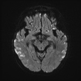Cerebral embolic infarcts (embolic shower) (Radiopaedia 72391-82921 Axial DWI 42).jpg