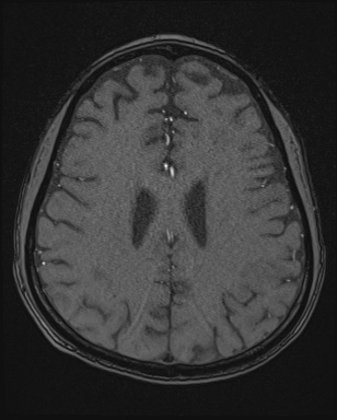 Cerebral embolic infarcts (embolic shower) (Radiopaedia 72391-82921 Axial MRA 137).jpg