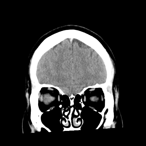 Cerebral hemorrhage secondary to arteriovenous malformation (Radiopaedia 33497-34561 C 14).png