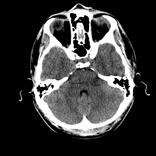 File:Cerebral hemorrhagic contusions- temporal evolution (Radiopaedia 40224-42753 Axial non-contrast 9).png