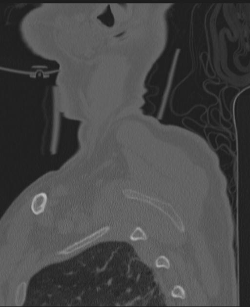 Cerebral hemorrhagic contusions and cervical spine fractures (Radiopaedia 32865-33841 Sagittal bone window 2).jpg