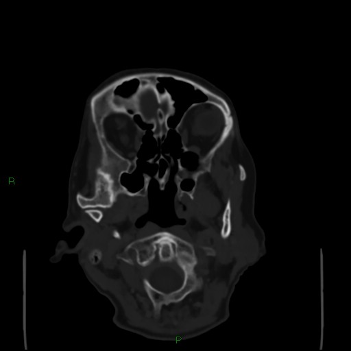 Cerebral metastases - breast primary (Radiopaedia 77653-89857 Axial bone window 11).jpg