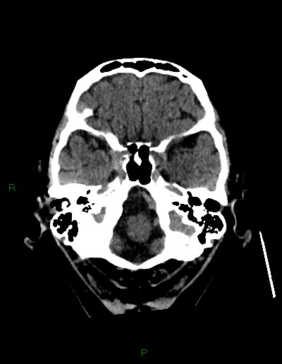 Cerebral metastases - ependymal and parenchymal (Radiopaedia 79877-93131 Axial non-contrast 10).jpg