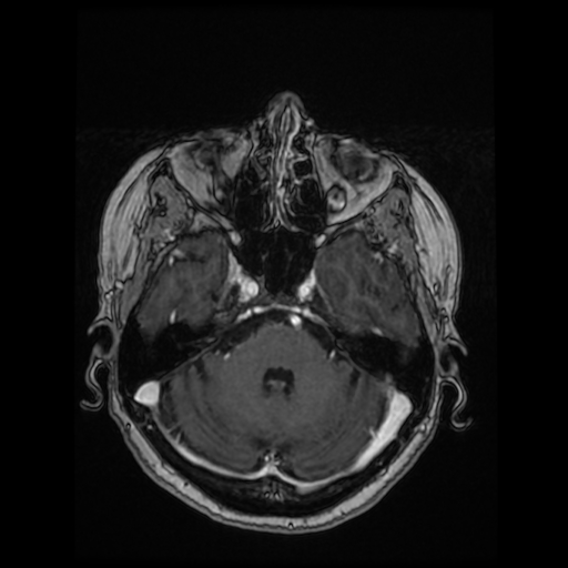 Cerebral metastases - melanoma (Radiopaedia 80972-94522 Axial T1 C+ 38).jpg