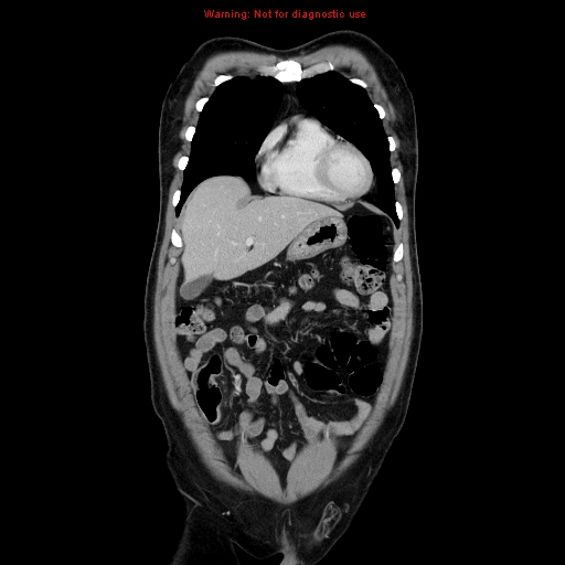 Cerebral metastasis - colorectal carcinoma (Radiopaedia 8581-83548 A 23).jpg