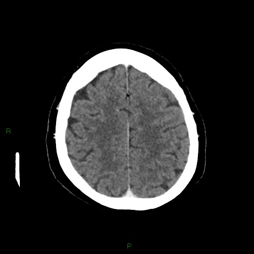 File:Cerebral metastasis from renal cell carcinoma (Radiopaedia 82306-96375 Axial C+ delayed 30).jpg