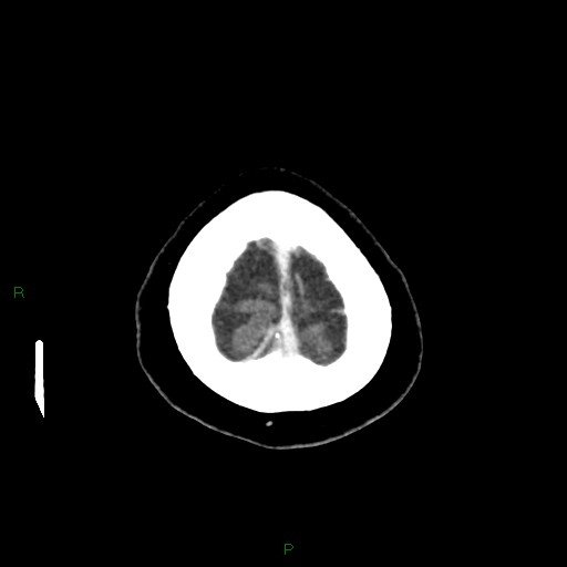 File:Cerebral metastasis from renal cell carcinoma (Radiopaedia 82306-96375 Axial C+ delayed 38).jpg