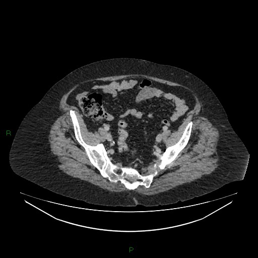 File:Cerebral metastasis from renal cell carcinoma (Radiopaedia 82306-96378 A 151).jpg