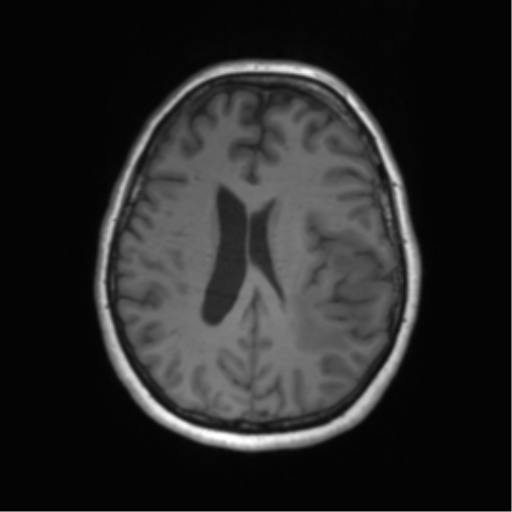 Cerebral metastasis mimicking glioblastoma (Radiopaedia 69155-78937 Axial T1 42).png