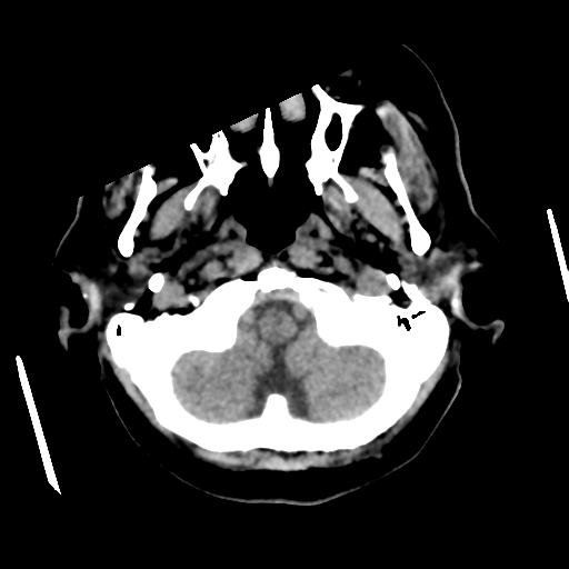 Cerebral metastasis to basal ganglia (Radiopaedia 81568-95412 Axial non-contrast 12).png