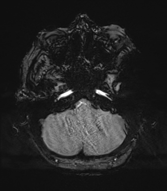 Cerebral metastasis to basal ganglia (Radiopaedia 81568-95413 Axial SWI 14).png