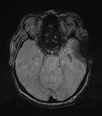 Cerebral metastasis to basal ganglia (Radiopaedia 81568-95413 Axial SWI magnitude 28).png