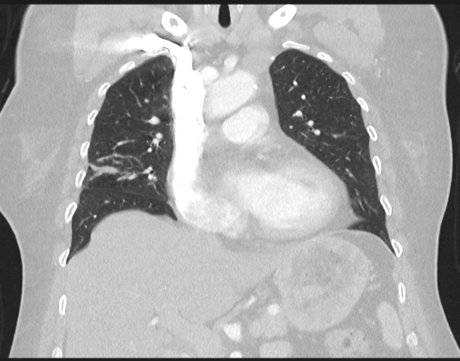 File:Cerebral metastasis to basal ganglia (Radiopaedia 81568-95414 Coronal lung window 37).png