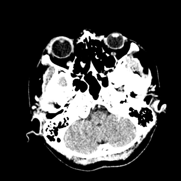 Cerebral ring enhancing lesions - cerebral metastases (Radiopaedia 44922-48818 B 53).jpg