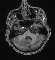 Cerebral toxoplasmosis (Radiopaedia 43956-47461 Axial T1 17).jpg