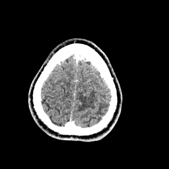 Cerebral toxoplasmosis (Radiopaedia 53993-60131 Axial C+ delayed 64).jpg