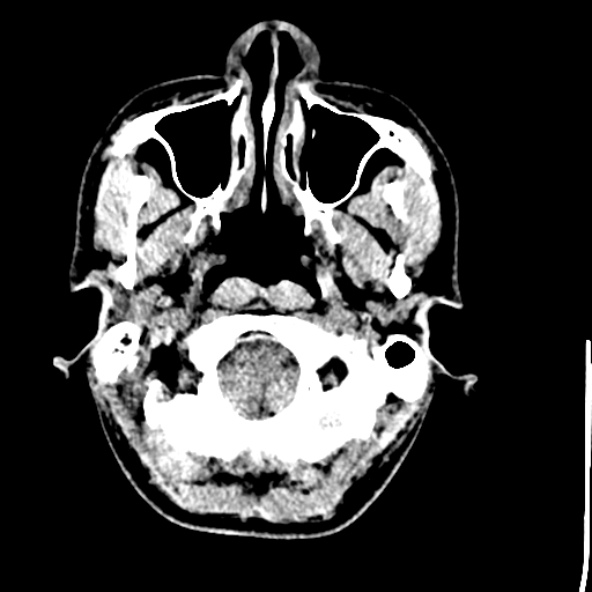Cerebral toxoplasmosis (Radiopaedia 53993-60131 Axial non-contrast 9).jpg