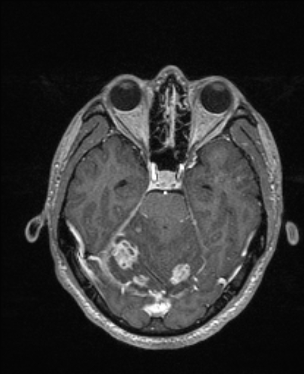 Cerebral toxoplasmosis (Radiopaedia 85779-101597 Axial T1 C+ 56).jpg