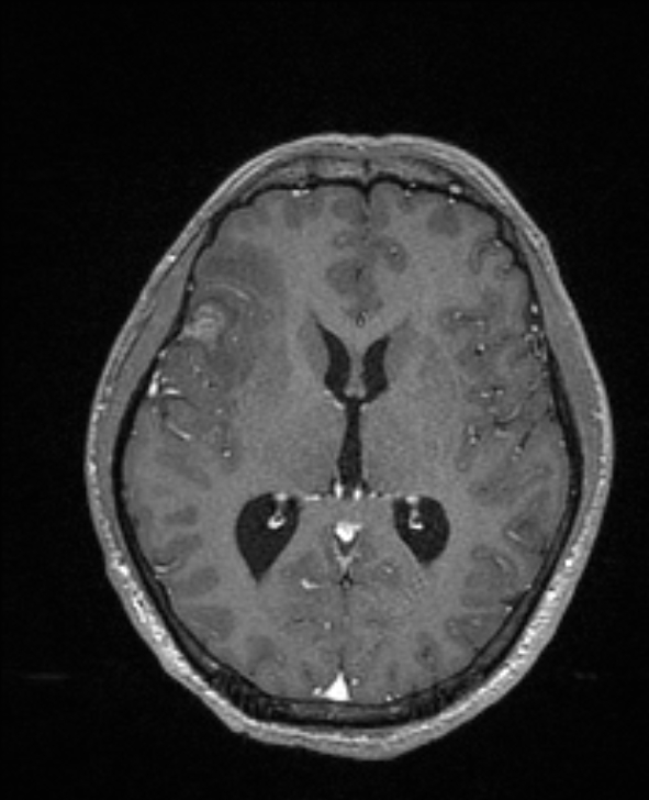 Cerebral toxoplasmosis (Radiopaedia 85779-101597 Axial T1 C+ 87).jpg