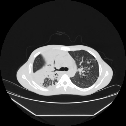 Cerebral tuberculoma (Radiopaedia 80829-94318 Axial lung window 59).jpg