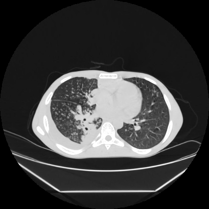 Cerebral tuberculoma (Radiopaedia 80829-94318 Axial lung window 96).jpg