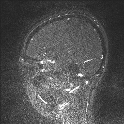 Cerebral tuberculosis with dural sinus invasion (Radiopaedia 60353-68090 Sagittal MRV 115).jpg