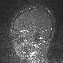 Cerebral tuberculosis with dural sinus invasion (Radiopaedia 60353-68090 Sagittal MRV 116).jpg