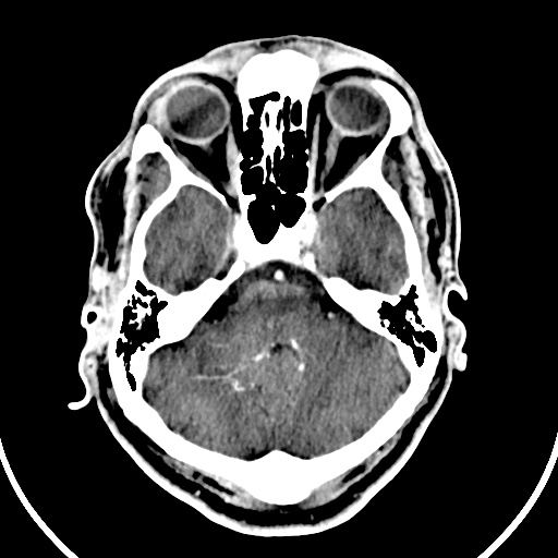 Cerebral venous angioma (Radiopaedia 69959-79977 B 12).jpg