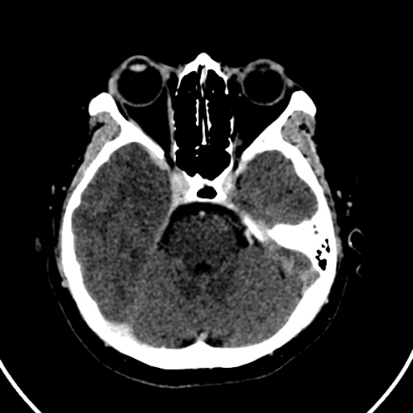 File:Cerebral venous hemorrhagic infarct from venous sinus thrombosis (Radiopaedia 55433-61883 Axial C+ delayed 104).jpg