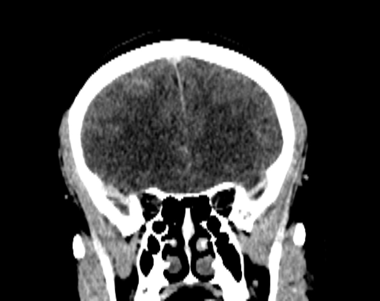 File:Cerebral venous hemorrhagic infarct from venous sinus thrombosis (Radiopaedia 55433-61883 Coronal C+ delayed 23).jpg