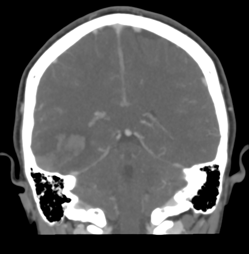 Cerebral venous hemorrhagic infarction (Radiopaedia 38461-40550 Coronal MIP VENOGRAM 39).png