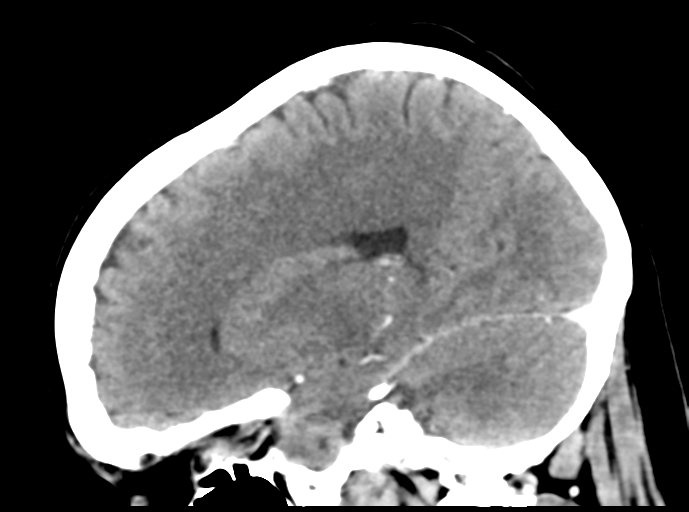 File:Cerebral venous hemorrhagic infarction (Radiopaedia 57576-64538 Sagittal C+ 33).png