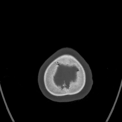 Cerebral venous infarction with hemorrhage (Radiopaedia 65343-74381 Axial bone window 188).jpg