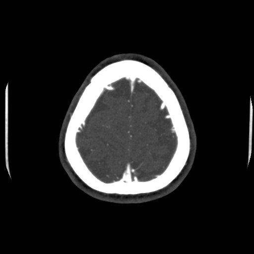Cerebral venous sinus thrombosis (Radiopaedia 40619-43227 A 203).jpg